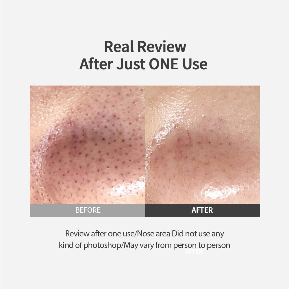 Melt Blackheads in 10 Minutes — No Pulling Needed