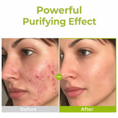 Purito Seoul Azelaic Acid 10 Kojic &amp; Tea Tree Serum, 30 ml / 1.01 fl oz